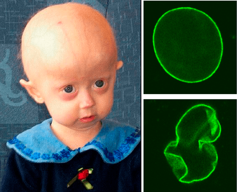Fallece Michiel Vandeweert (28) de Diepenbeek por progeria