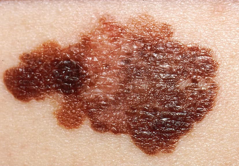 Veelbelovende resultaten van het vaccin tegen kanker van Moderna en Merck