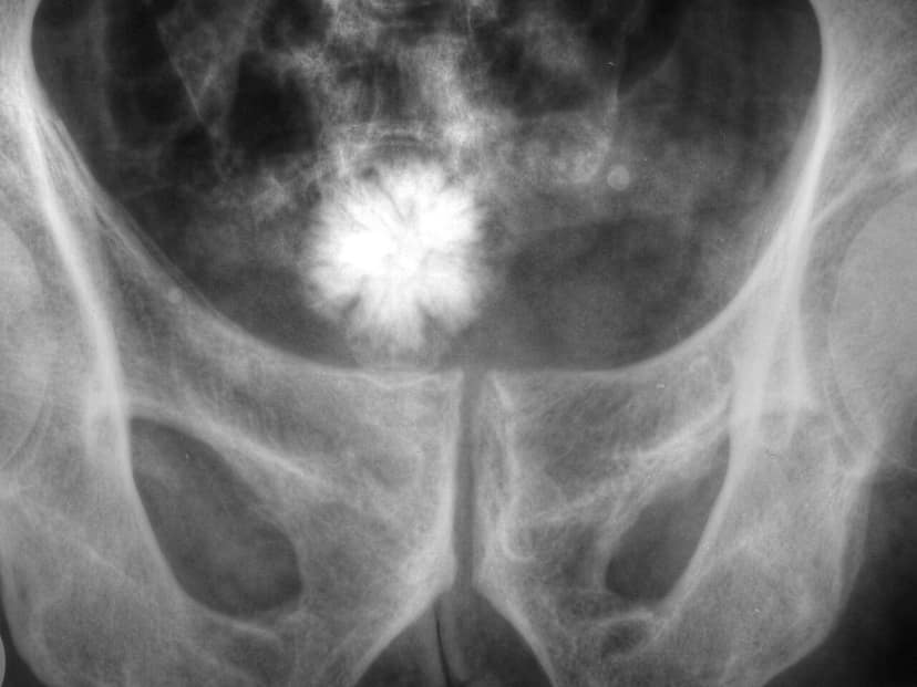 Un ospedale dello Sri Lanka rimuove un calcolo vescicale da 3,1 kg, rivendicando un record