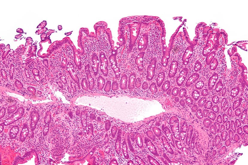 Challenges for celiac disease patients at festivals