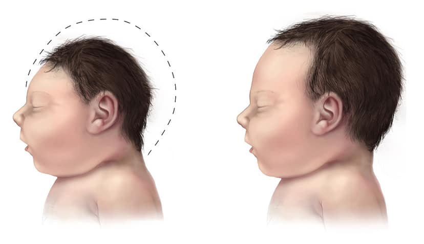 Archieffoto: Eerste menselijke besmetting met shamondavirus in Frankrijk