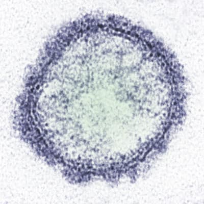 Foto de archivo: Francia confirma el primer caso humano del virus Shamonda; el paciente muere